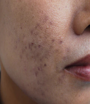 Hyperpigmentation