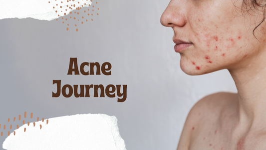 What Is Acne and How to Treat It: Causes, Types & Effective Solutions