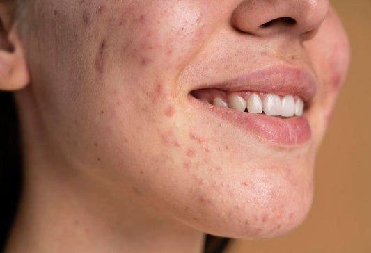 What is the Best Skincare for Dry Skin?