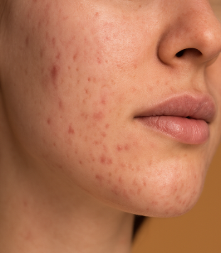 Hormonal Acne