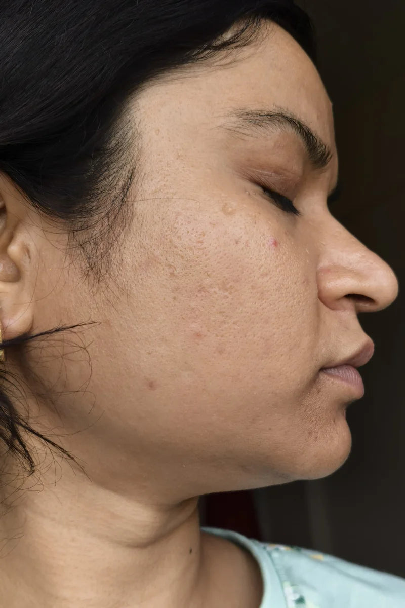 Alisha after treatment
