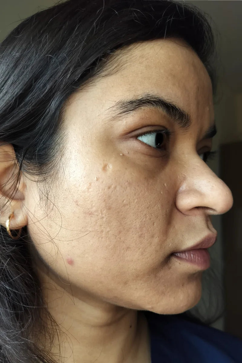 Alisha before treatment