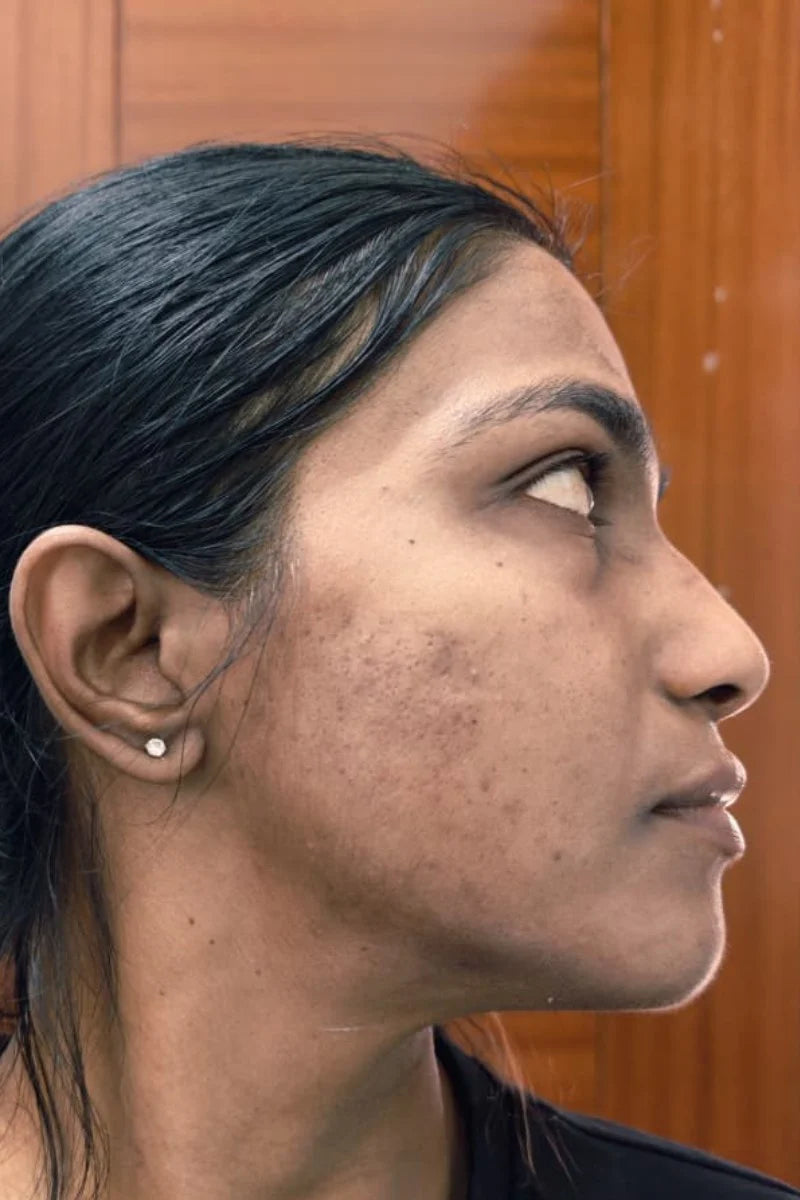 Ira after treatment