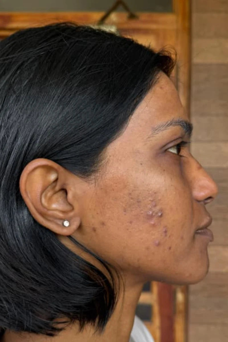 Ira before treatment
