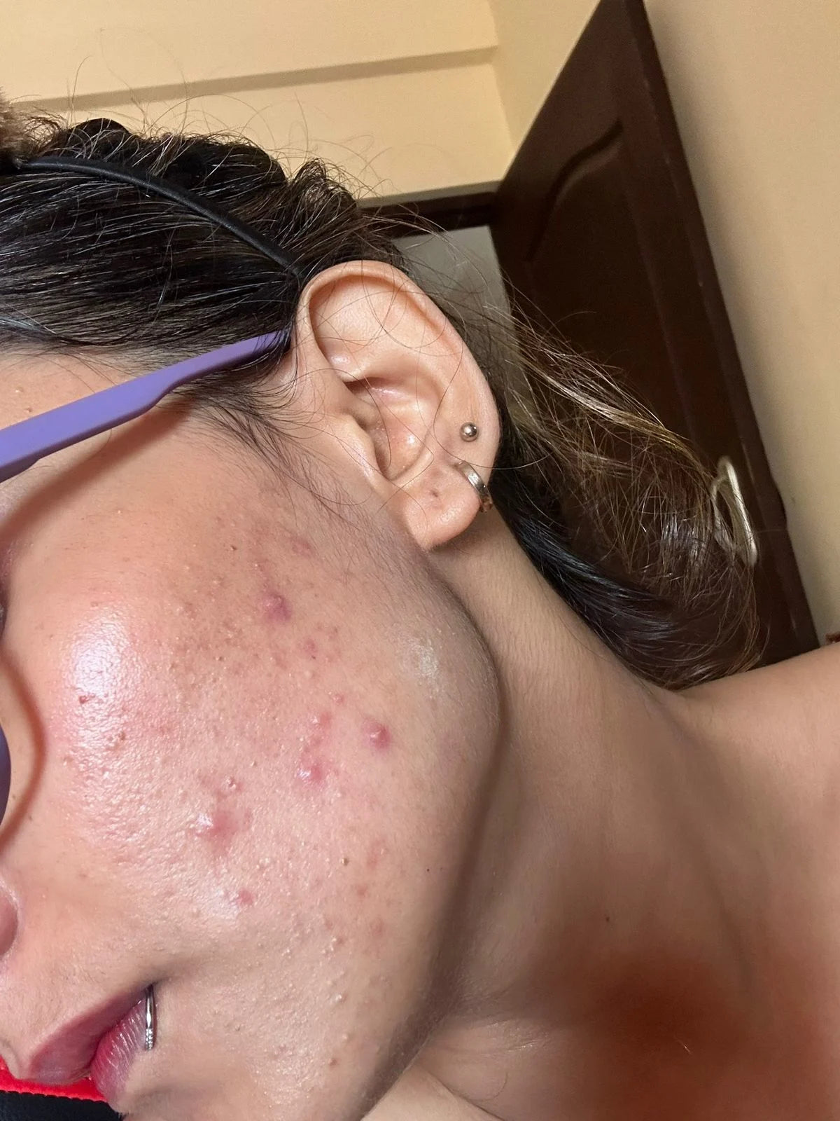 Sneha before treatment
