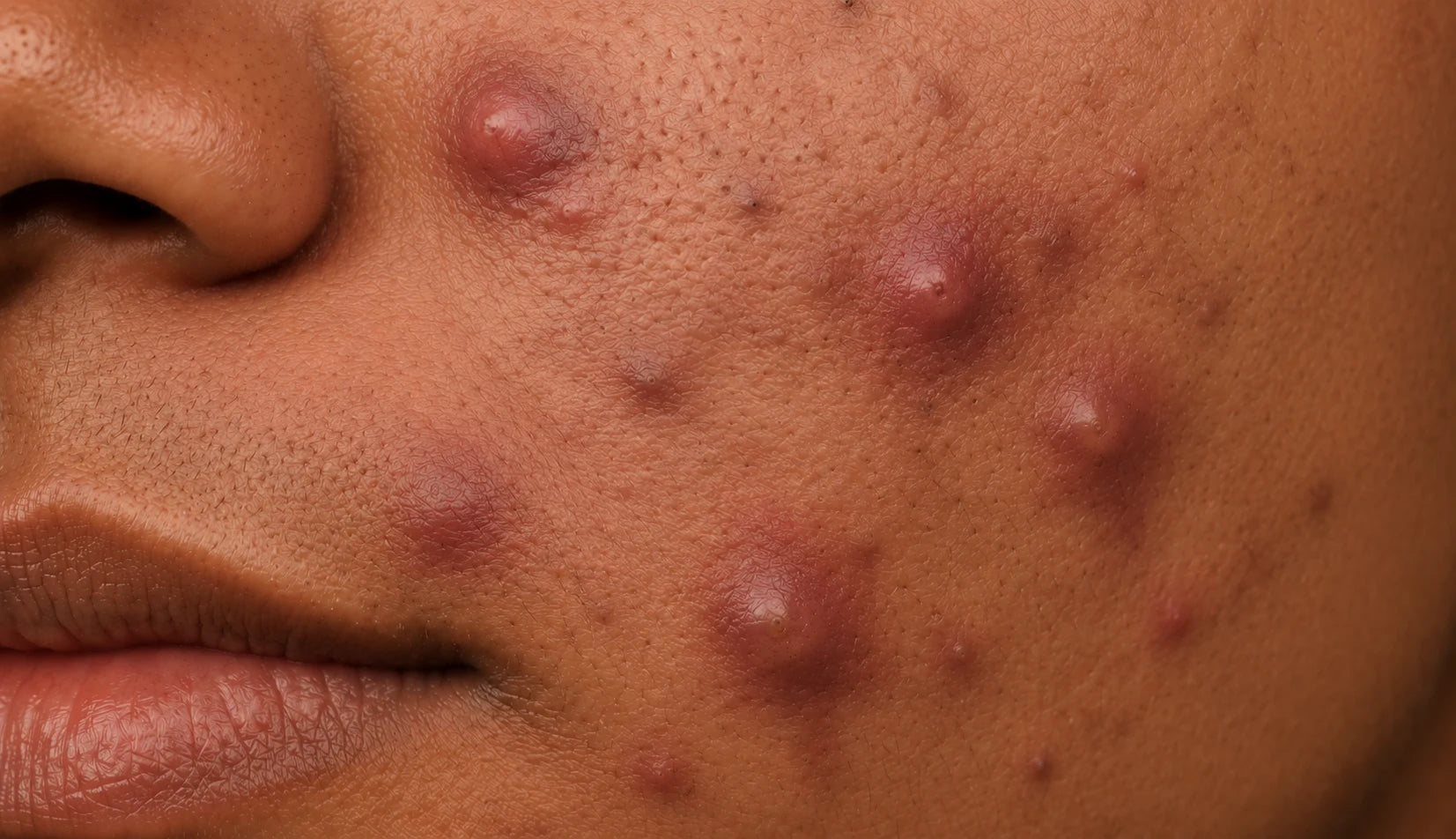 Cystic Acne