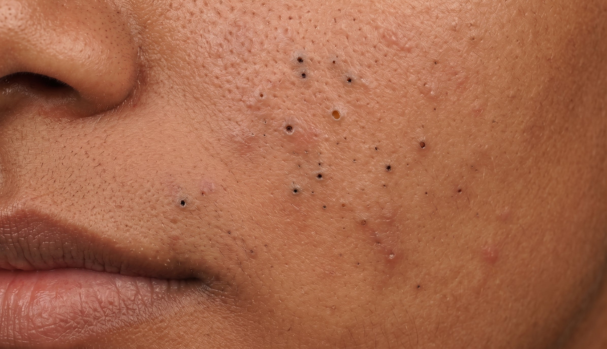 Blackheads