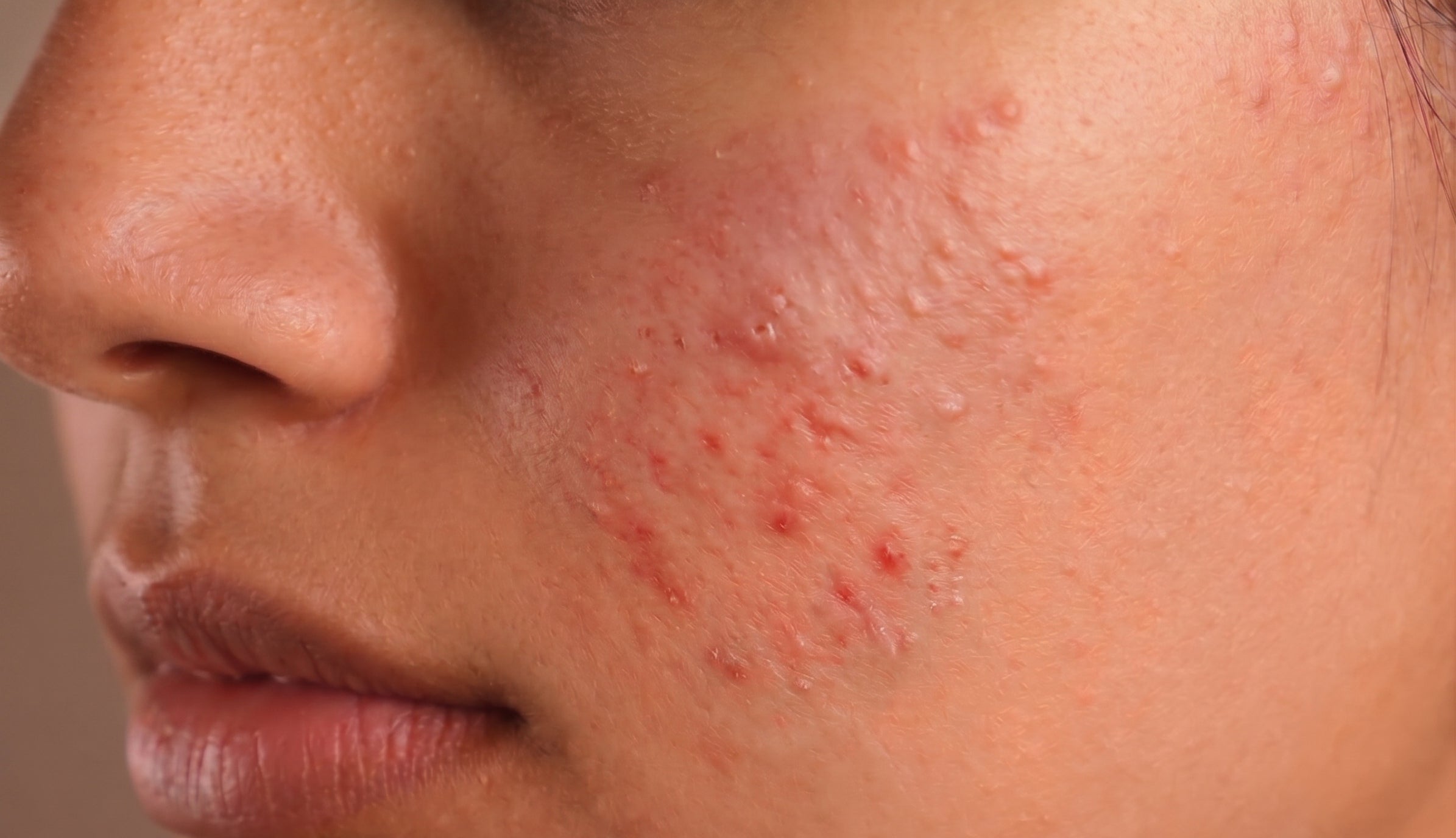 Pustules