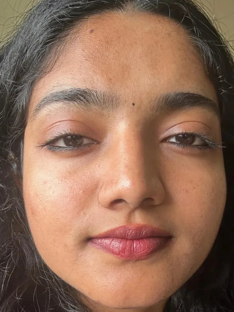 Aarohi after treatment