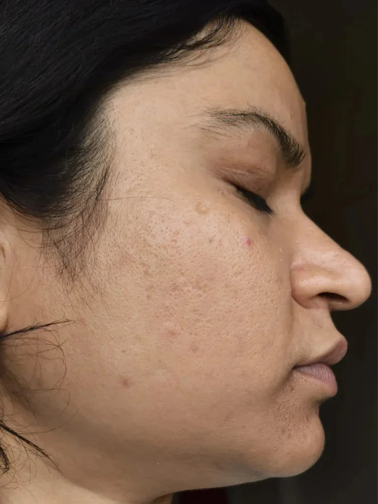 Alisha after treatment