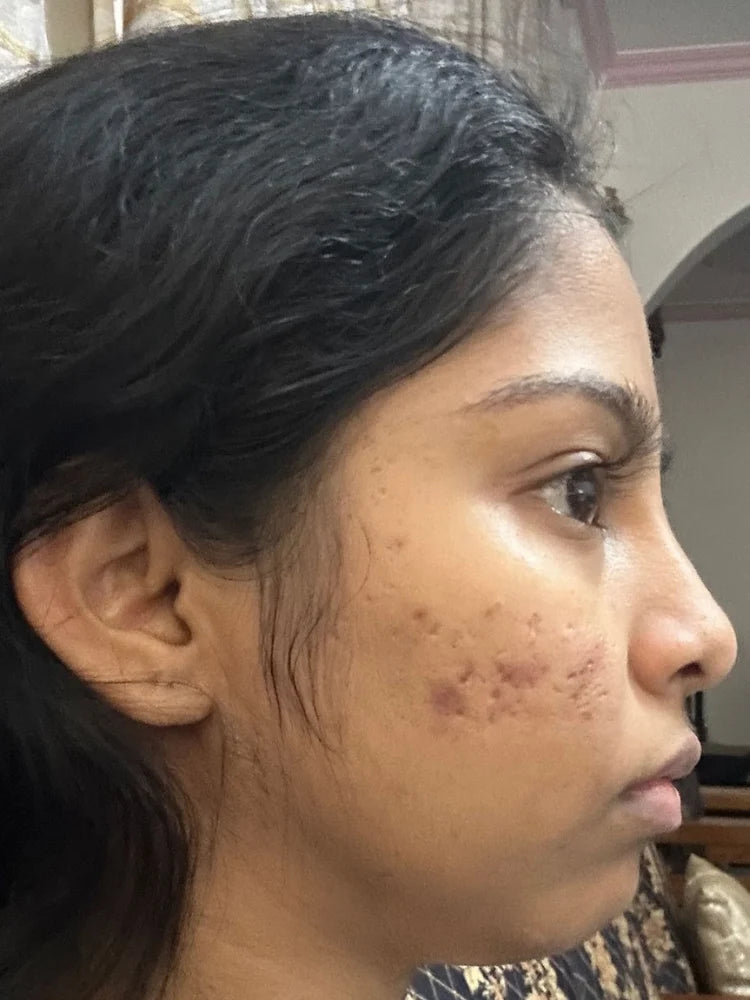 Anjali after treatment