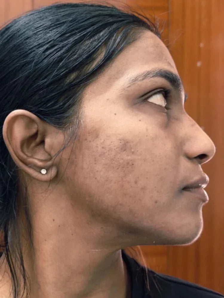 Ira after treatment