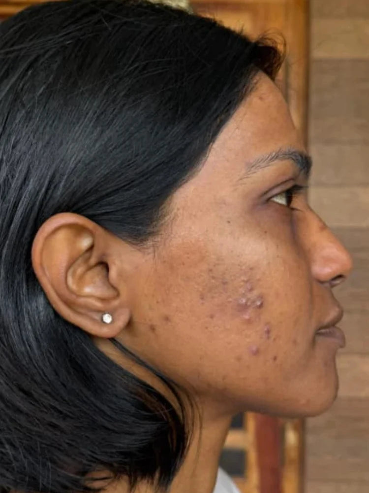 Ira before treatment
