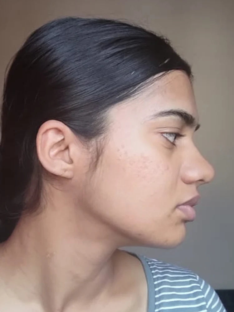 Meera after treatment