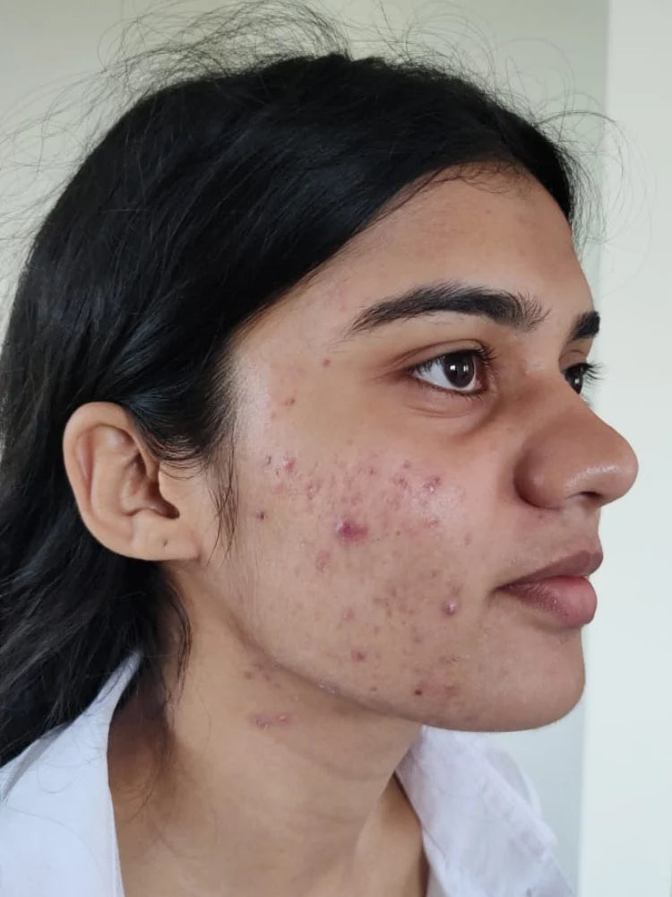 Meera before treatment