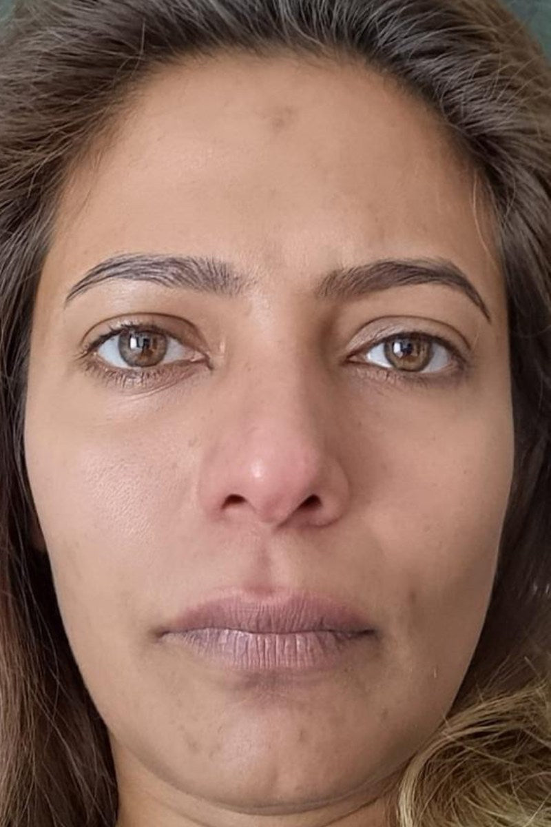 After 2 months treating Anti-Ageing