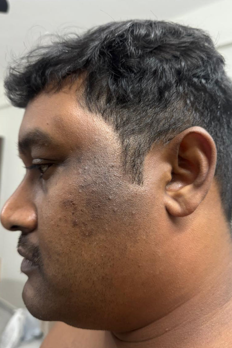 Before treating Scarring