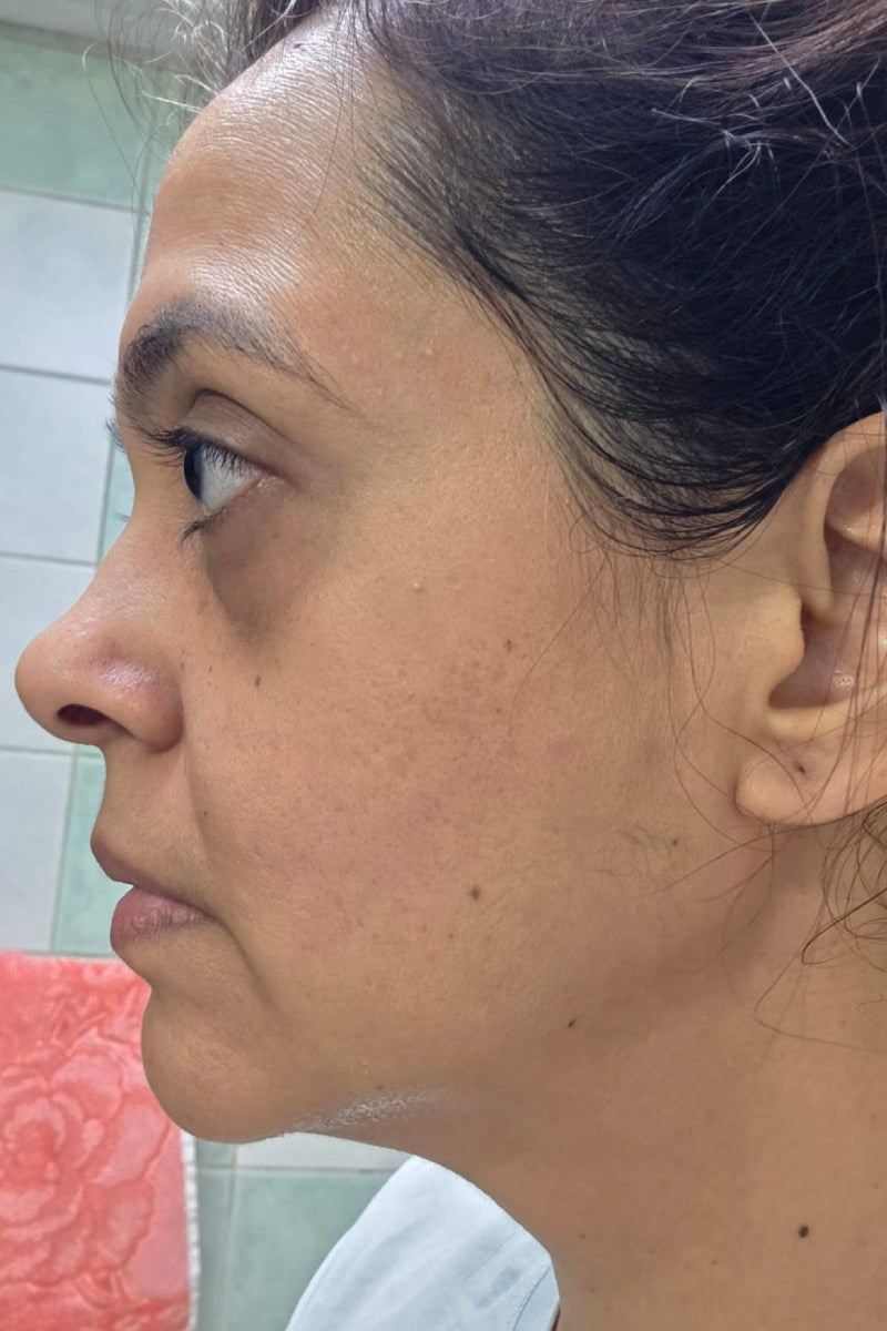 After 3 months treating Anti-Ageing