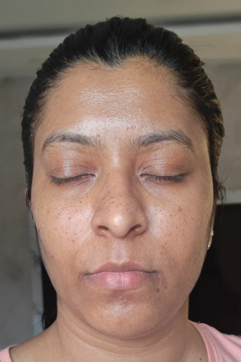 After 4 months treating Glow