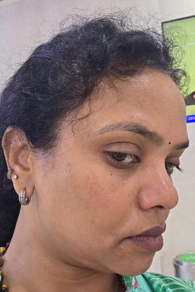 After 6 months treating Hyperpigmentation