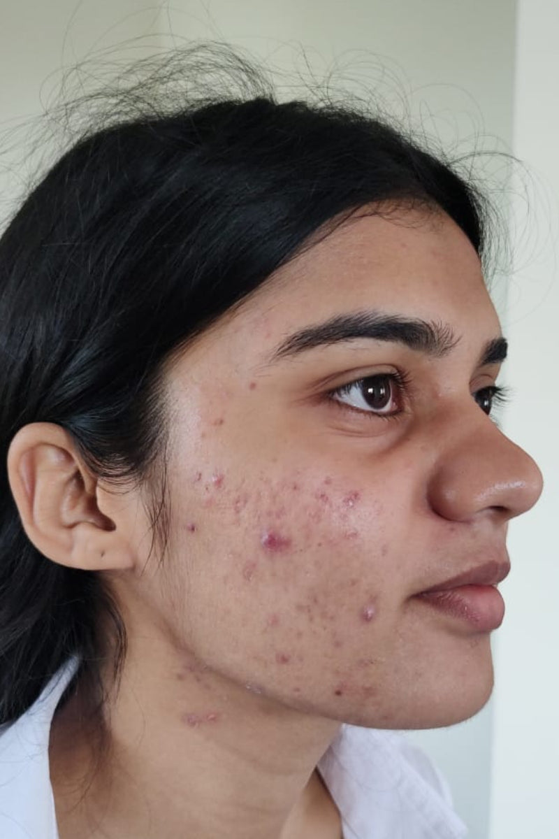 Before treating Acne