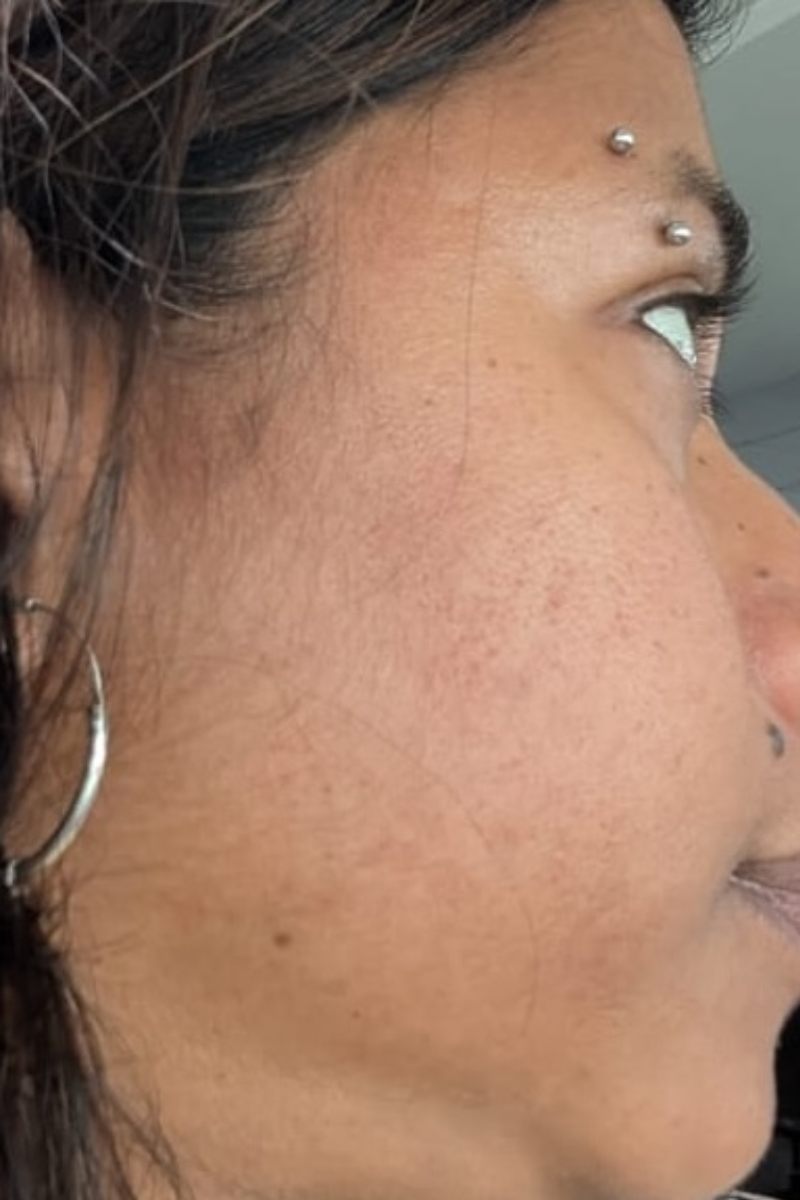 After 8 months treating Scarring