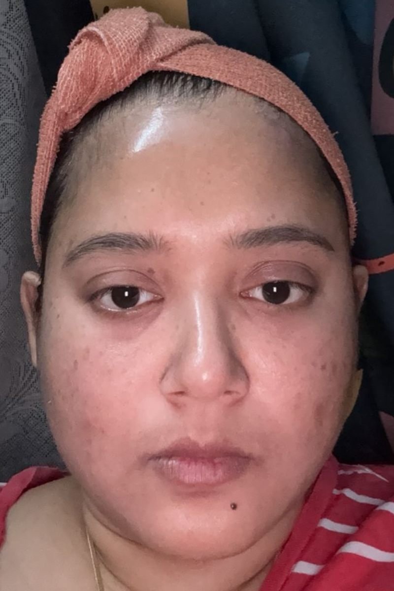 After 2 months treating Hyperpigmentation